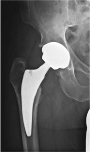 Das Röntgenbild zeigt eine eingesetzte...