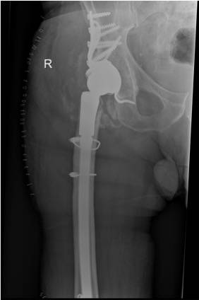 Einer der größeren endoprothetischen Eingriffe: eine Gelenkpfannenrekonstruktion des...