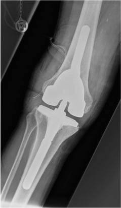 Eine Röntgenaufnahme nach ausgewechselter...